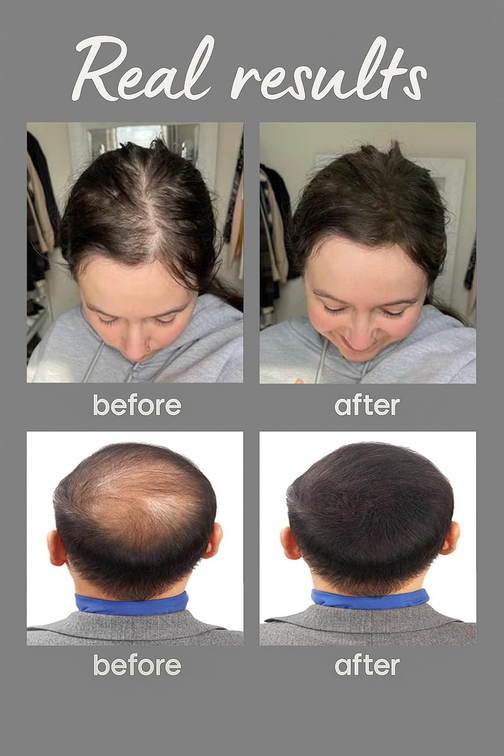 Hair Building Fibres for Thinning Hair – Natural & Undetectable Hair Loss Concealer – Wind & Sweat Resistant – 27.5g (Black)