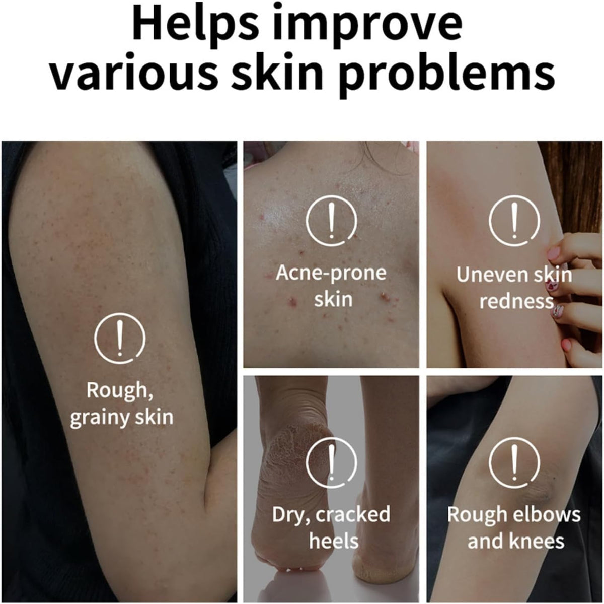 Exfoliating Body Stick with AHA 7% + BHA 0.5% – Solid Body Scrub for Smooth & Soft Skin – Non-Messy Body Exfoliator with Shea Butter – For Arms, Legs, Underarms, Inner Thighs & Rough Areas