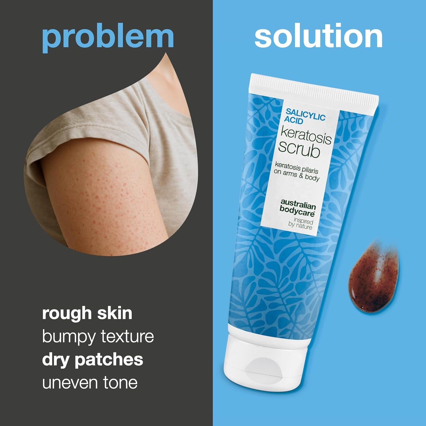 Keratosis Pilaris Body Scrub Treatment – Chemical (AHA/BHA) + Physical Exfoliant for Strawberry Legs, KP & Ingrown Hair with Salicylic Acid, Glycolic Acid, Apricot Seed & Allantoin