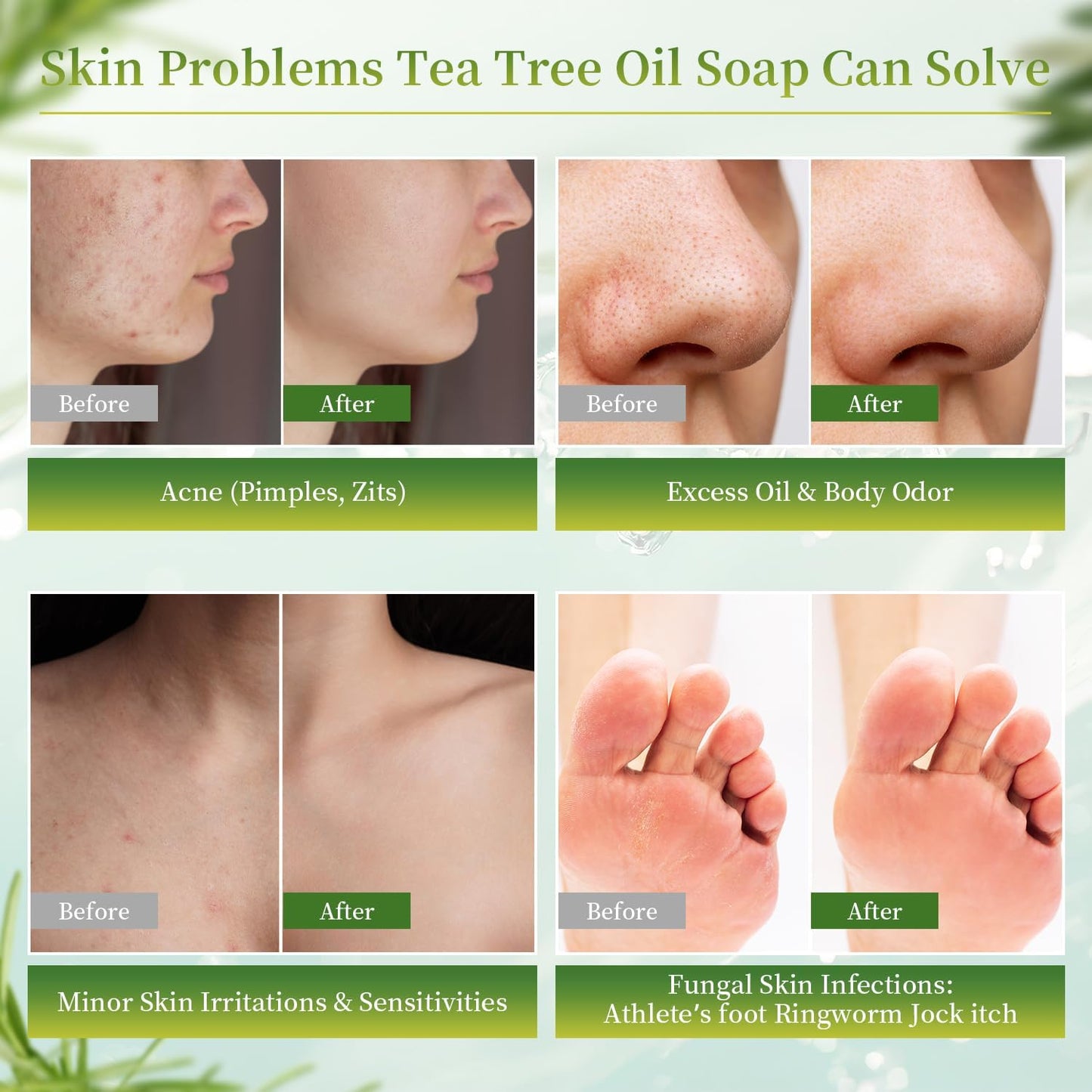 3 PCS Tea Tree Antifungal Soap Bar, Tea Tree Oil Soap for Face Body Hand - Fights Acne, Relieves Fungal Skin, Controls Oil, Clears Pores, Prevents Breakouts, Soothes Fresh Skin (3, Green-B)