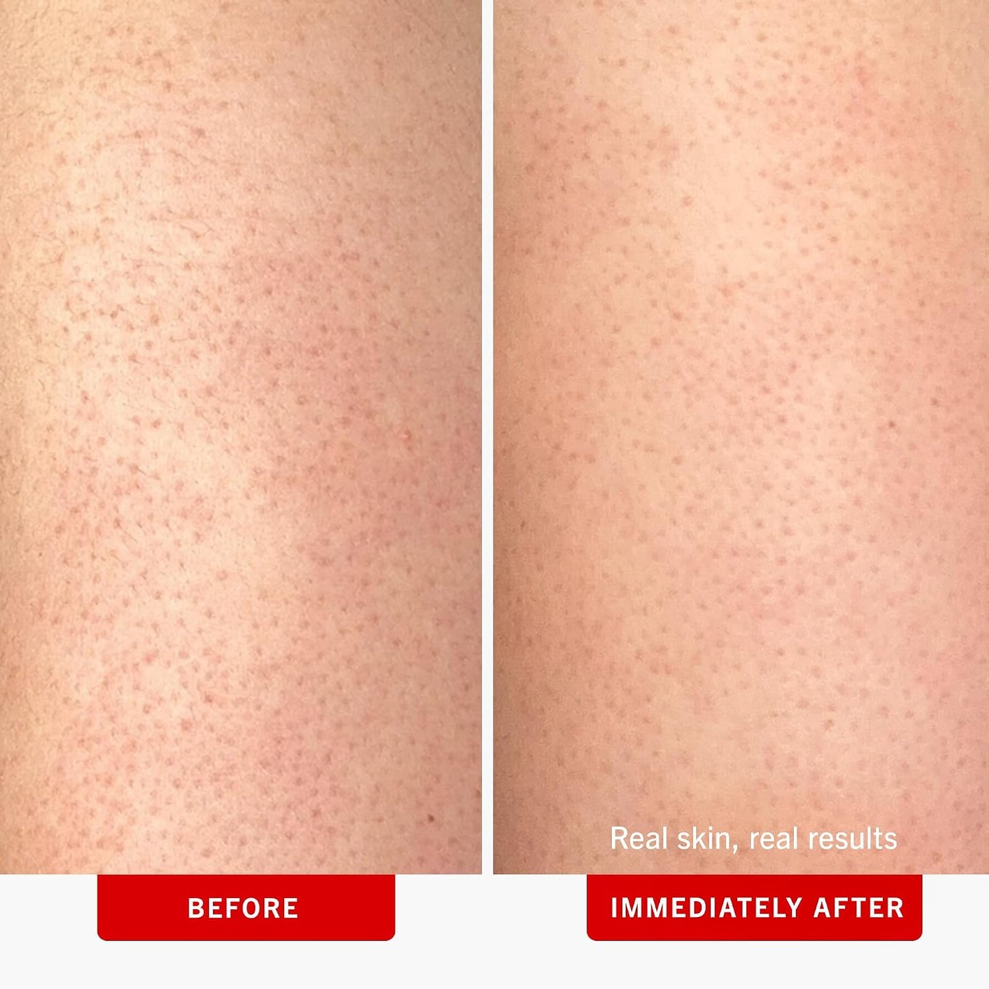 First Aid Beauty - KP Bump Eraser Body Scrub with 10% AHA, Keratosis Pilaris Exfoliater with Glycolic and Lactic acids, Helps Reduce Chicken Skin Bumps, Safe for Sensitive Skin, Strawberry Scent, 226g