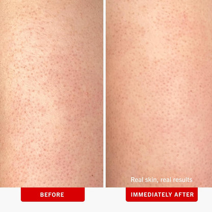 First Aid Beauty - KP Bump Eraser Body Scrub with 10% AHA, Keratosis Pilaris Exfoliater with Glycolic and Lactic acids, Helps Reduce Chicken Skin Bumps, Safe for Sensitive Skin, Strawberry Scent, 226g