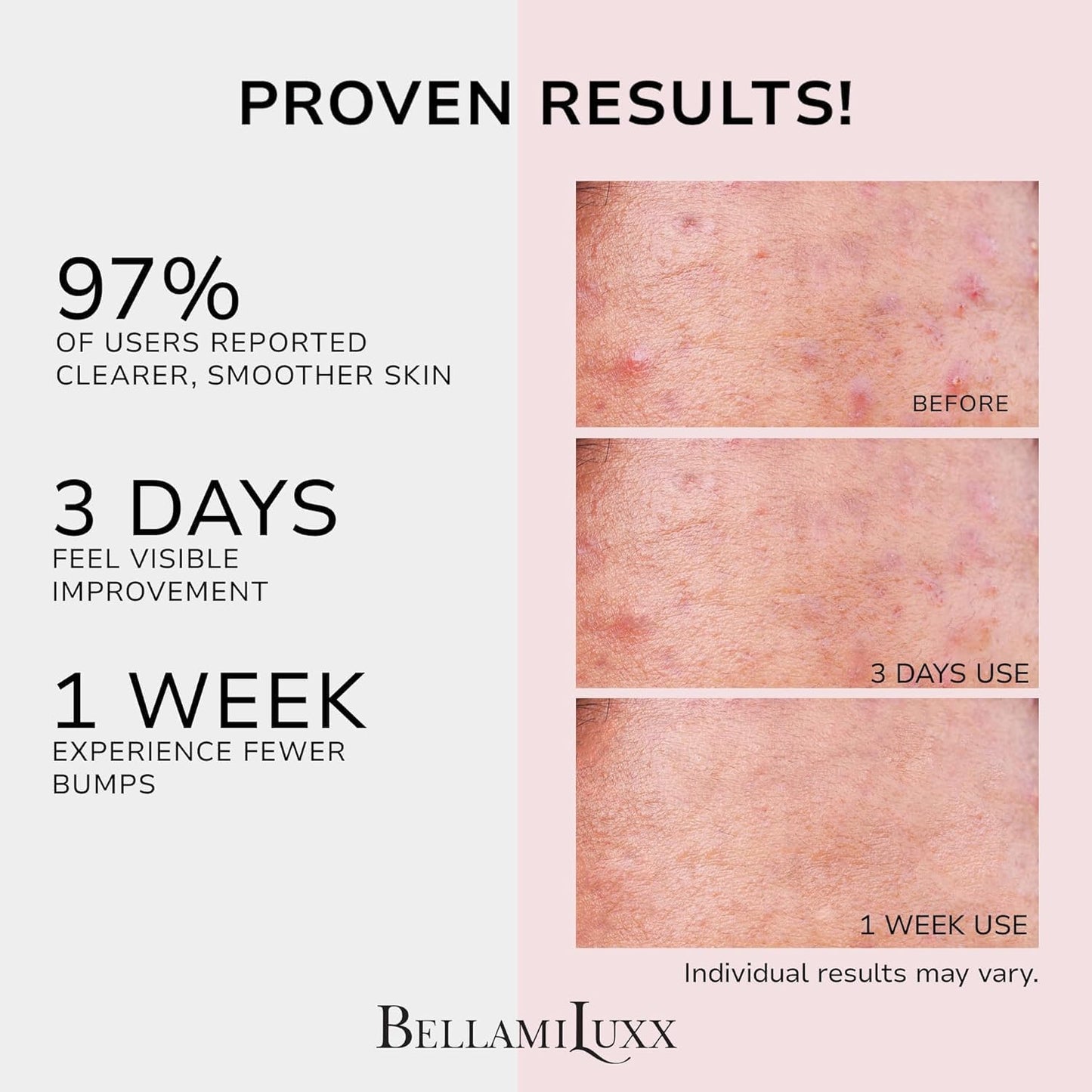BellamiLuxx Butt Acne Clearing Treatment Cream: Body Acne Treatment Lotion for Folliculitis and Pimples on Back, Buttocks, Thighs With 2% Salicylic Acid &amp; Tea Tree Oil - Butt Cream for Smooth Skin
