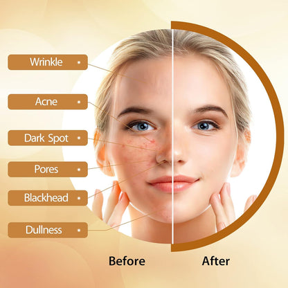 Kojic Acid Soap, with Turmeric &amp; Vitamins C, Dark Spot Remover for Face and Body, 100g x3 Moisturizing for Acne Blackheads Remover, Hyaluronic Acid for Deep Cleansing, with a Mesh Pouch