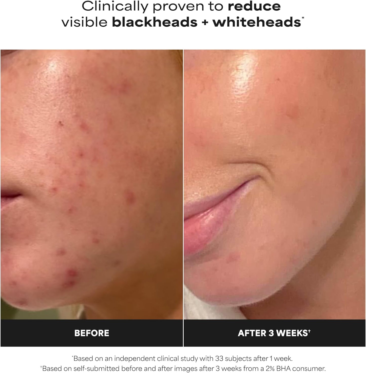 Paula's Choice SKIN PERFECTING 2% BHA Liquid Exfoliant - Face Exfoliating Peel Fights Blackheads &amp; Enlarged Pores - for a Healthy Glow - with Salicylic Acid - Combination &amp; Oily Skin - 30 ml
