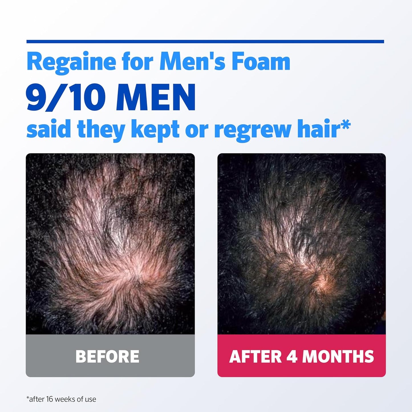 Regaine Extra Strength Foam – a practical take on male hair regrowth