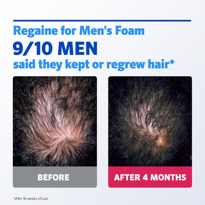 Regaine Extra Strength Foam – a practical take on male hair regrowth