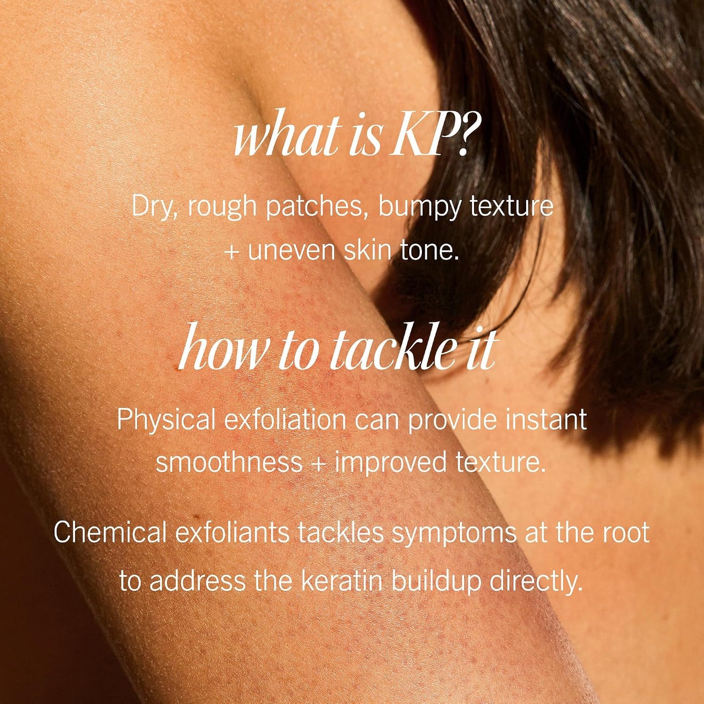 First Aid Beauty - KP Bump Eraser Body Scrub with 10% AHA, Keratosis Pilaris Exfoliater with Glycolic and Lactic acids, Helps Reduce Chicken Skin Bumps, Safe for Sensitive Skin, Strawberry Scent, 226g
